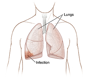 Front view of chest showing lungs with infection.