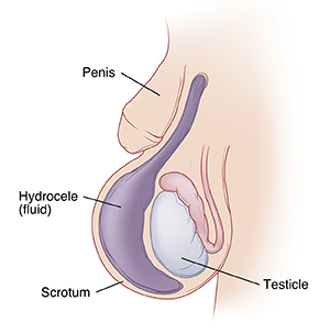 Closeup of baby's penis and scrotum showing testicle inside. Large sac of fluid (hydrocele) is inside scrotum and enlarging it.