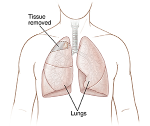 Front view of male chest showing lungs with shaded area showing tissue to be removed.