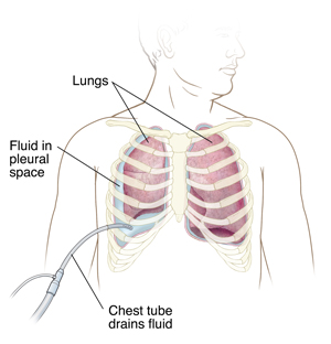 Front view of man's chest showing tube draining fluid from space next to lung.