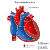 Anatomy of a heart with a coarctation of the aorta
