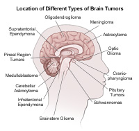 Location of different types of tumors