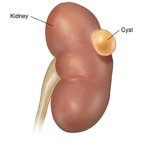 Front view of kidney with simple cyst.