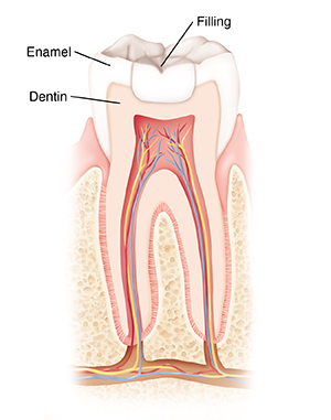 Cross section of tooth showing filling.