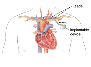 Outline of person's chest showing pacemaker in chest with leads going into heart chambers.