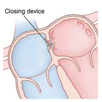 Front view cross section of upper heart showing right and left atria. Closing device is in septum between atria.