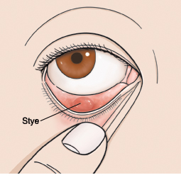 Closeup of eye with finger holding down lower eyelid to show stye.
