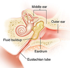 Cross section of child's ear showing fluid in middle ear.
