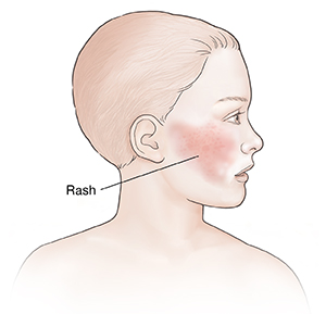 Side view of child with head turned to side showing red rash on cheek.