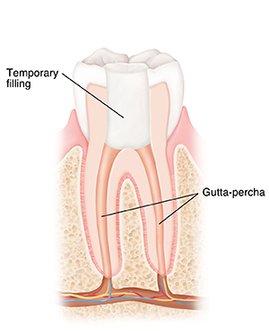 Cross section of tooth showing temporary filling after root canal. 