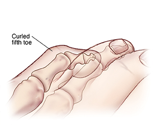 Top view of curled fifth toe.