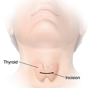 Front view of head and neck showing thyroid and incision location.