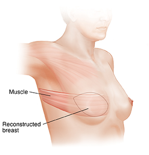 Side view of female chest showing LD flap breast reconstruction.