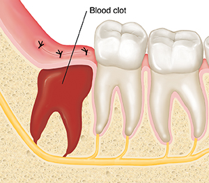 Closeup cross section of jawbone and molars showing blood clot where wisdom tooth was removed.