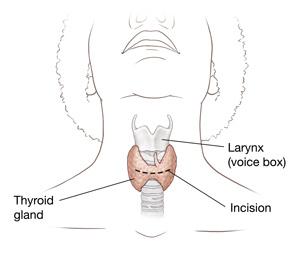 Front view of head and neck showing thyroid and incision location.