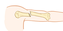 Upper arm bone showing displaced fracture.