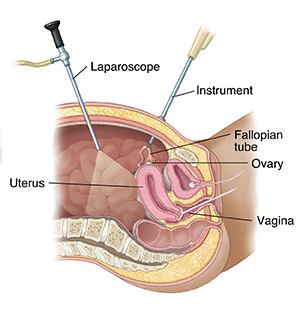 Cross section of female pelvis from the side showing laparoscopy.