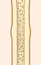 Cross section of bone showing healed fracture.