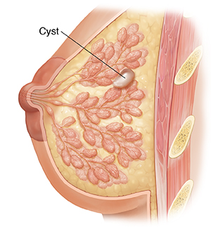 Cross-section view of breast with cyst.