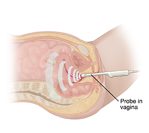 Cross section of female pelvis viewed from the side. Ultrasound transducer is in vagina.