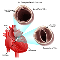 Illustration of aortic stenosis