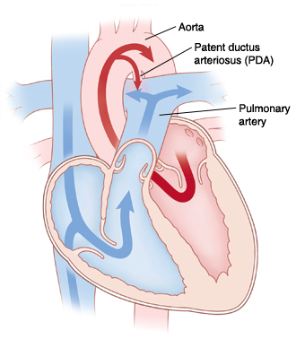 Cross section of heart showing patent ductus arteriosus.