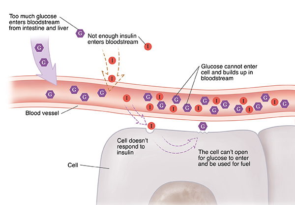 Closeup cross section of blood vessel near cells showing Type 2 diabetes. Cell doesn't respond to insulin. Glucose can't enter cells and builds up in bloodstream.