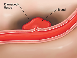 Cross section of ruptured artery in brain causing hemorrhagic stroke. 