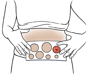 Female abdomen showing hands holding measuring guide to stoma.