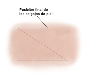 Incisión cutánea de Z-plastia después de que los colgajos se han desplazado a su posición.