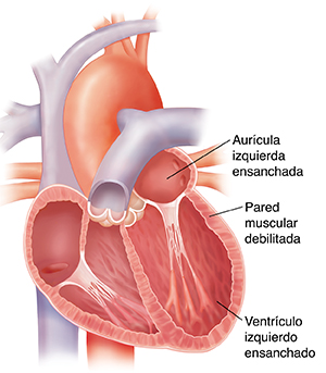 Corte transversal de un corazón agrandado. Las paredes del corazón son delgadas.