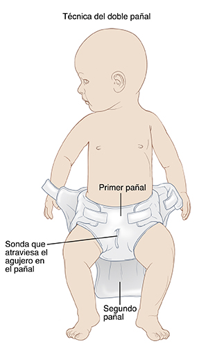 Niño acostado boca arriba con un pañal puesto. Se hace un agujero en el pañal encima del pene. La sonda sale por el agujero. Se coloca un segundo pañal para cubrir el primero y la sonda.