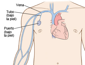 Contorno del pecho de un hombre que muestra el corazón en su interior. El puerto se encuentra debajo de la piel de la parte superior derecha del pecho. El tubo que sale del puerto está insertado en un vena que va hacia el corazón.