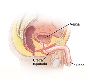 Corte transversal visto de lado de un cuerpo masculino en el que se observan los intestinos, el recto, la vejiga, la próstata, el pene, los testículos y la uretra con estenosis.