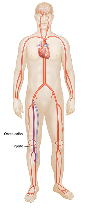 Vista frontal de figura masculina que muestran un injerto de derivación distal.