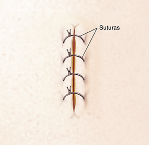 Incisión cerrada con suturas.
