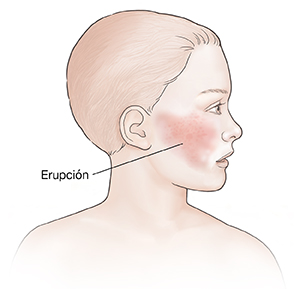 Vista lateral de un niño con la cabeza hacia un lado con un sarpullido en la mejilla.