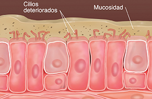 Células con cilios dañados que muestran acumulación de mucosidad y partículas en la mucosidad.