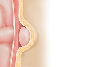 Corte transversal de una pared corporal donde puede verse una hernia. El intestino sobresale por el defecto en el músculo debajo de la piel.