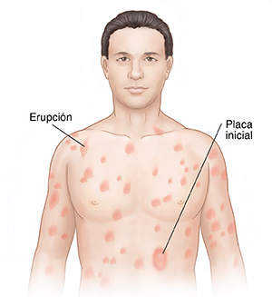 Vista frontal de la cabeza y el pecho de un hombre donde puede verse pitiriasis rosada.