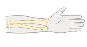 Vista frontal de una fractura en espiral de tibia.