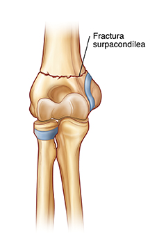 Vista frontal de una articulación de codo que muestra una fractura supracondílea.