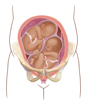 Front view cross section of uterus in pelvic bones showing two fetuses.