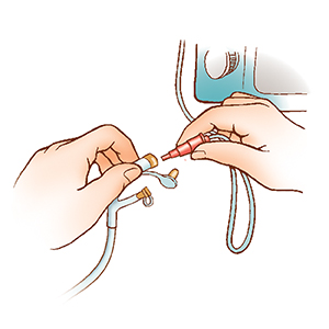 Close-up of hands holding plug-in feeding bag syringe and plug-in feeding tube port.