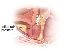 Cross section of prostate gland showing inflammation.