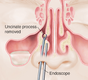 Closeup of instruments inserted in nose, removing piece of bone.