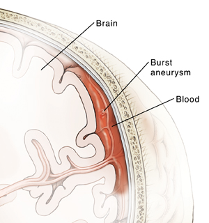 Cutaway view of ventricles showing enlarged ventricles and subarachnoid space