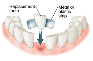 Closeup of resin-bonded bridge being fitted on prepared teeth.